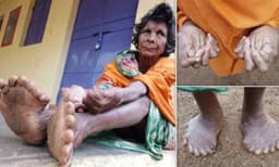 ആകെ 31 വിരലുകള്‍; മന്ത്രവാദിനി എന്ന് വിളിച്ച് ഗ്രാമവാസികള്‍ ആട്ടിപ്പായിച്ച കുമാരിക്ക് ഗിന്നസ് റെക്കോര്‍ഡ്