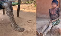 ശരീരം മീന്‍ ചെതുമ്പലിനു സമാനമായി 'കല്ലായി' മാറുന്നു : അത്യപൂര്‍വരോഗത്തിന്റെ നരകയാതന തിന്ന് ഏഴു വയസുകാരി