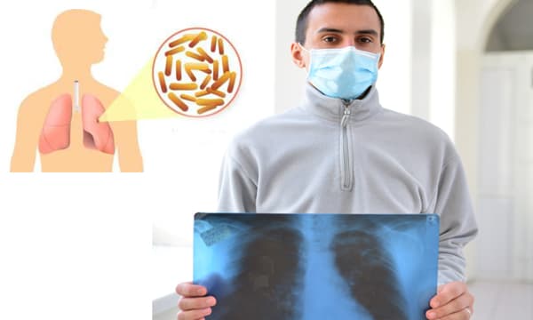 ക്ഷയരോഗവുമായി ബന്ധപ്പെട്ട് സാധാരണ ഉയര്‍ന്നു കേള്‍ക്കുന്ന സംശയങ്ങളും അവയ്ക്കുള്ള മറുപടിയും.