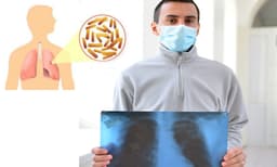 ക്ഷയരോഗവുമായി ബന്ധപ്പെട്ട് സാധാരണ ഉയര്‍ന്നു കേള്‍ക്കുന്ന സംശയങ്ങളും അവയ്ക്കുള്ള മറുപടിയും.