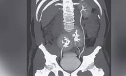 അസഹനീയമായ നടുവേദനയുമായി ആശുപത്രിയില്‍ എത്തിയ യുവാവിനെ പരിശോധിച്ച ഡോക്ടര്‍ ഞെട്ടി, വൃക്കകള്‍ രണ്ടല്ല, മൂന്ന് 