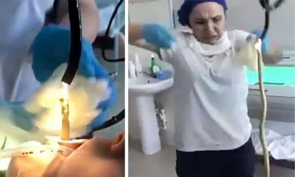 ശസ്ത്രക്രിയയിലൂ​ടെ സ്ത്രീയുടെ വായയിലൂടെ പുറത്തെടുത്തത് നാലടിയോളം നീളമുള്ള പാമ്പിനെ ; വീഡിയോ