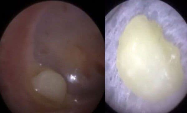 ചെവി വേദനയുമായെത്തിയ മൂന്നുവയസ്സുകാരന്റെ ചെവിക്കുള്ളിൽ പല്ല് 