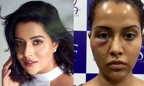 ശസ്ത്രക്രിയ പിഴവ് ; നീരുവന്ന മുഖവുമായി തമിഴ് നടി റെയ്‌സ വില്‍സണ്‍