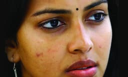 മുഖക്കുരു അകറ്റാന്‍ ടിപ്‌സ് 
