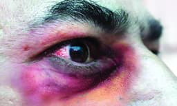 ബ്ലാക്ക് ഫംഗസ് അറിയേണ്ടതെല്ലാം 