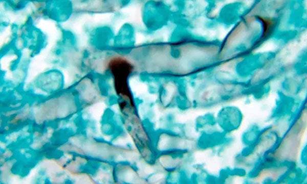 New Black Fungus Case Reported In Ernakulam