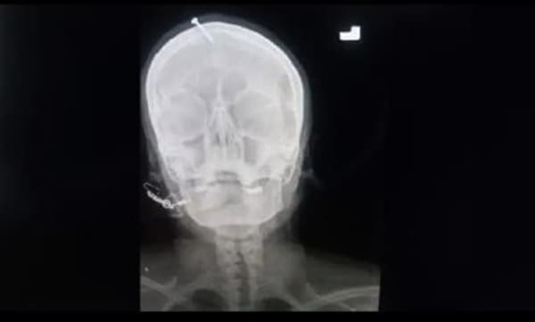 ആണ്‍കുഞ്ഞിനെ പ്രസവിക്കുമെന്ന് വിശ്വസിപ്പിച്ച് ഗര്‍ഭിണിയുടെ തലയോട്ടിയില്‍ ആണി അടിച്ചിറക്കി