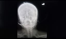 ആണ്‍കുഞ്ഞിനെ പ്രസവിക്കുമെന്ന് വിശ്വസിപ്പിച്ച് ഗര്‍ഭിണിയുടെ തലയോട്ടിയില്‍ ആണി അടിച്ചിറക്കി