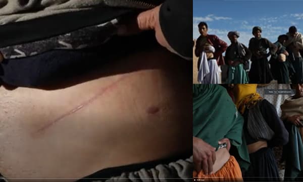 വൃക്ക വിറ്റ് പട്ടിണി മാറ്റി അഫ്ഗാനി സ്ത്രീകള്‍, താലിബാന്റെ വരവോടെ കത്തിമുനയിലകപ്പെട്ട് ജനങ്ങള്‍