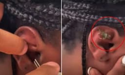 യുവതിയുടെ ചെവിയില്‍ നിന്ന് പുറത്തെടുത്തത് ജീവനുള്ള ഞണ്ടിനെ; വീഡി​യോ