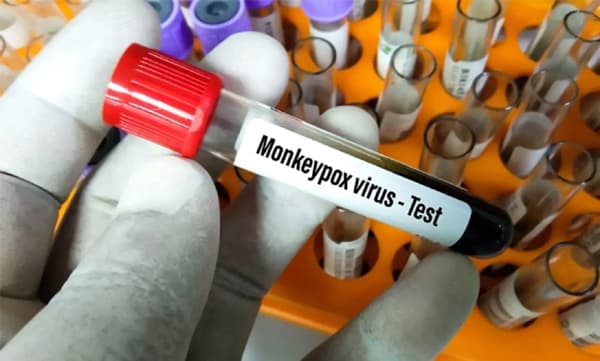 'കുരങ്ങുപനി വര്‍ധിക്കാന്‍ സാധ്യത'; ഭയമല്ല ജാഗ്രതയാണ്  വേണ്ടതെന്ന് ഡബ്ല്യുഎച്ച്ഒ