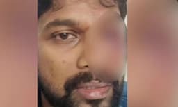 പ്രതിഷേധ മാർച്ചിനിടെ പരുക്കേറ്റ യൂത്ത് കോൺ ഗ്രസ് നേതാവിന് കാഴ്ച്ച നഷ്ടമായി; കൺപോളയിൽ 28 തുന്നലുകള്‍