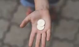 പത്തു വര്‍ഷം മുമ്പ് മൂക്കില്‍ കുടുങ്ങിയ നാണയം പുറത്ത് വന്നത് നിസാരമായി