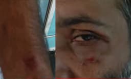 മുണ്ടക്കയത്ത് വീണ്ടും കുറുക്കന്റെ ആക്രമണം; കര്‍ഷകന് പരിക്കേറ്റു