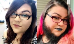 ഒമ്പത് വയസ് മുതല്‍ താടിയില്‍ രോമം വളരാന്‍ തുടങ്ങി. ഇന്ന് ഷേവ് ചെയ്യാത്ത താടിയില്‍ ഹാപ്പിയാണിവള്‍
