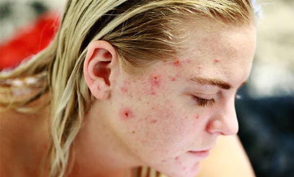 മുഖക്കുരുവിനെ ചെറുക്കാന്‍ ഈ ഭക്ഷണങ്ങള്‍ ഒഴിവാക്കാം
