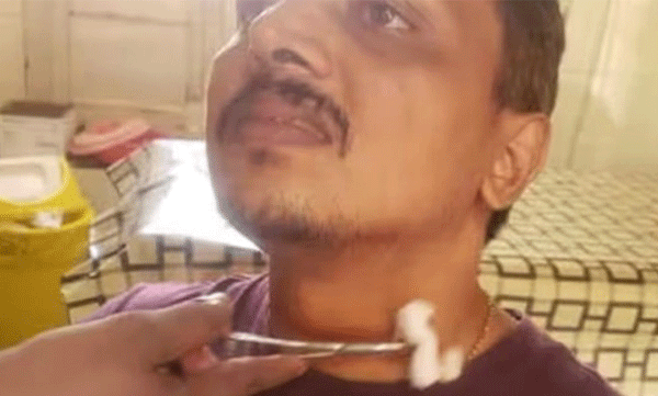  കൊച്ചിയില്‍ കേബിള്‍ കഴുത്തില്‍ കുരുങ്ങിയുണ്ടായ അപകടത്തില്‍ ബൈക്ക് യാത്രികന് പരിക്കേറ്റു