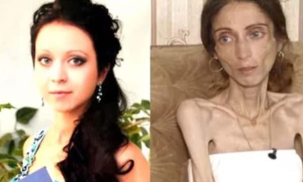 തടിയുടെ പേരില്‍ നിരന്തരം പരിഹസിച്ചു. 22 കിലോ കുറച്ച യുവതി ഇപ്പോള്‍ ആശുപത്രിയില്‍, പിന്നാലെ ഭര്‍ത്താവ് ഉപേക്ഷിച്ചു


