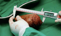 ഇതുവരെ കണ്ടതില്‍ വച്ച് ഏറ്റവും വലുത്: ഗിന്നസ് വേള്‍ഡ് റെക്കോര്‍ഡ് മൂത്രത്തില്‍ കല്ല് 