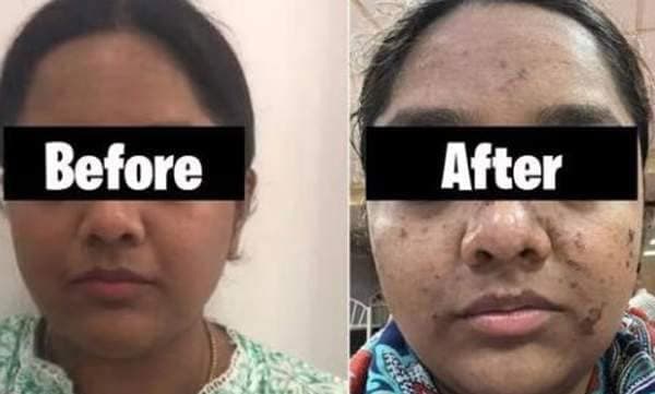17,500 രൂപയുടെ ഹൈഡ്രാ ഫേഷ്യല്‍ ചെയതു, പിന്നാലെ മുഖം പൊള്ളി, സലൂണ്‍ ഉടമയ്ക്കെതിരെ കേസെടുത്ത് പൊലീസ്
