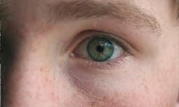 മുഖത്ത് വന്നിരുന്ന പ്രാണിയെ അടിച്ചുകൊന്നു: ചൈനയില്‍ യുവാവിന് ഇടത് കണ്ണിന്റെ  കാഴ്ച നഷ്ടമായി 

