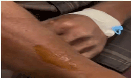 വയനാട്ടിൽ വീണ്ടും വന്യജീവി ആക്രമണം; റാട്ടകൊല്ലിയിൽ യുവാവിനെ പുലി ആക്രമിച്ചു