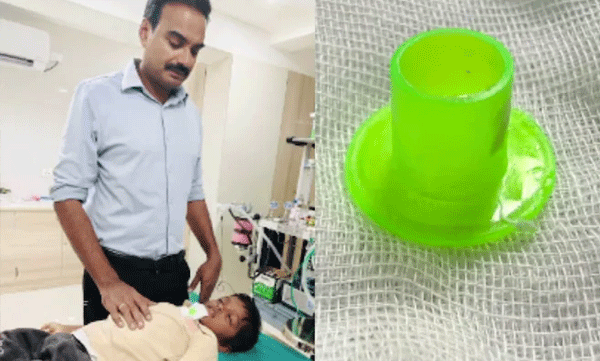 ഒരു വർഷമായി അസഹ്യമായ തൊണ്ടവേദന; ആറ് വയസ്സുകാരന്റെ്‌ തൊണ്ടയിൽ കുടുങ്ങിയത് കളിപ്പാട്ടത്തിലെ പ്ലാസ്റ്റിക്