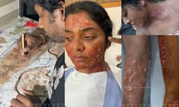 ഒരു പ്രാണി കടിച്ചാല്‍ ത്വക്കിന് എന്ത് സംഭവിക്കും?4 മണിക്കൂര്‍ കഷ്ടപ്പെട്ട റിമ കല്ലിങ്കലിന്റെ പ്രോസ്തെറ്റിക് മേക്കപ്പ് വീഡിയോ പങ്കിട്ട് മേക്കപ്പ് ആര്‍ട്ടിസ്റ്റ് സേതു ശിവാനന്ദന്‍