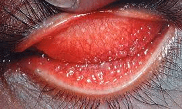  ട്രക്കോമയെ പൂർണമായും നീക്കം ചെയ്ത് ഫിജി; രോഗത്തെ തടയുന്ന 26മത് രാജ്യം