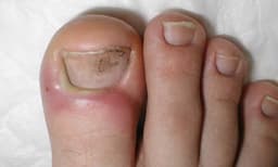 നഖങ്ങള്‍ ശരിയായ രീതിയില്‍ സംരക്ഷിച്ചില്ലെങ്കിലും കുഴിനഖങ്ങള്‍ പ്രത്യക്ഷപ്പെടാം
