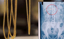 സ്വര്‍ണമാല മോഷ്ടിച്ച് വിഴുങ്ങിയ യുവതിയെ മെഡിക്കൽ കോളേജ് ആശുപത്രിയിലേക്ക് മാറ്റി