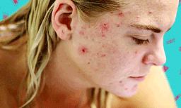 പുരുഷന്മാരേ...മുഖക്കുരു പണി തരാറുണ്ടോ ? ; ഇക്കാര്യങ്ങള്‍ ചെയ്ത് നോക്കൂ
