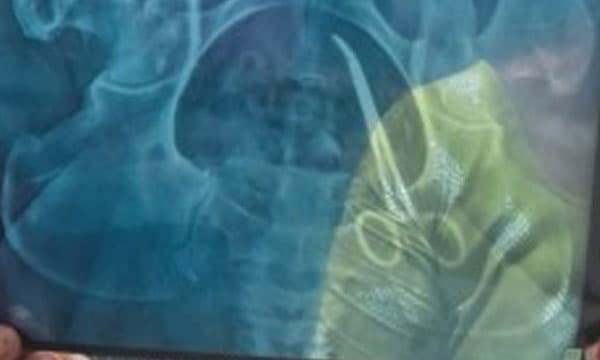 വീട്ടമ്മയുടെ വയറ്റില്‍ മറന്നു വെച്ച കത്രിക പുറത്തെടുക്കല്‍ ; ശസ്ത്രക്രിയ അമൃതയില്‍ ഉടന്‍ നടക്കും