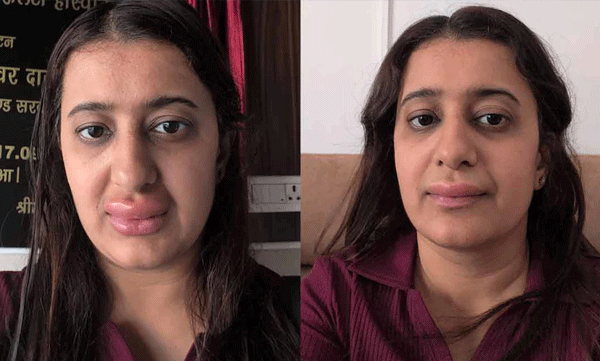 വന്ദേഭാരതിലെ ഭക്ഷണം കഴിച്ചതിന് പിന്നാലെ ചുണ്ടുകള്‍ തടിച്ചുവീര്‍ത്തു: ഗുരുതര ആരോപണവുമായി യാത്രക്കാരി 
