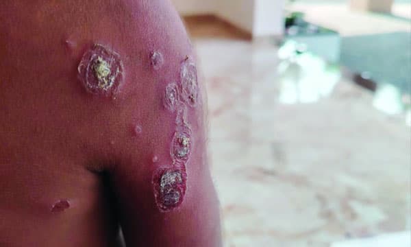 സംസ്ഥാനത്ത് മൂന്ന് കുട്ടികളടക്കം അഞ്ചുപേര്‍ക്ക് സൂര്യാതപമേറ്റു; പൊള്ളലേറ്റവരില്‍ അംഗനവാടി അദ്ധ്യാപികയും തടിമില്ല് തൊഴിലാളിയും