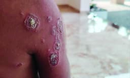 സംസ്ഥാനത്ത് മൂന്ന് കുട്ടികളടക്കം അഞ്ചുപേര്‍ക്ക് സൂര്യാതപമേറ്റു; പൊള്ളലേറ്റവരില്‍ അംഗനവാടി അദ്ധ്യാപികയും തടിമില്ല് തൊഴിലാളിയും