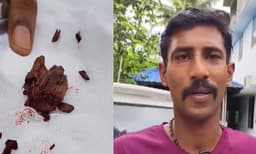 ‘തുന്നലിട്ട കാലില്‍നിന്ന് 2 മാസങ്ങള്‍ക്ക് ശേഷം മരക്കഷണങ്ങള്‍ പുറത്തെടുത്തു’; തിരുവനന്തപുരം മെഡിക്കൽ കോളജിൽ വീണ്ടും ചികിത്സാ പിഴവ്
