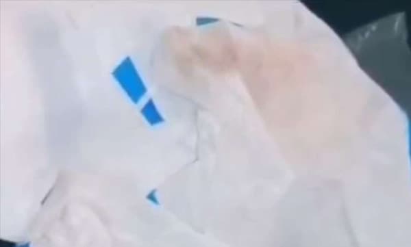 പാരിയാരം മെഡിക്കല് കോളേജില് നല്കിയ പിപിഇ കിറ്റില് ചോരക്കറ
