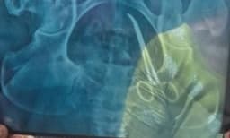 വീട്ടമ്മയുടെ വയറ്റില് മറന്നു വെച്ച കത്രിക പുറത്തെടുക്കല് ; ശസ്ത്രക്രിയ അമൃതയില് ഉടന് നടക്കും