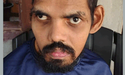 മഞ്ചേരി മെഡിക്കൽ കോളേജിൽ ചികിത്സയിലിരിക്കെ മരിച്ചയാൾക്ക് ഷിഗെല്ല സ്ഥിരീകരിച്ചു